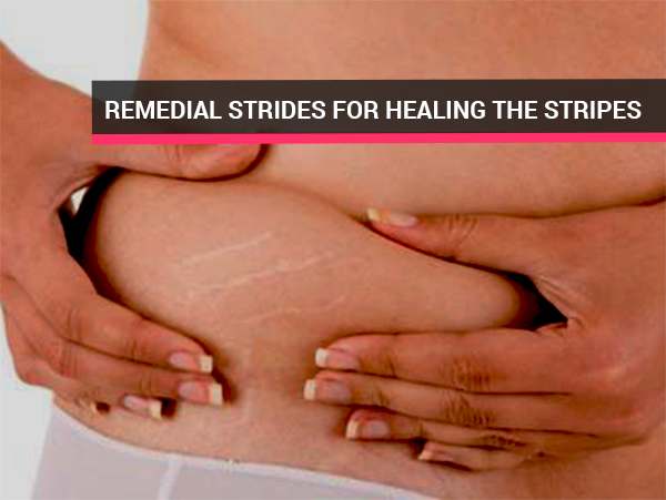 remedies-for-stretch-marks