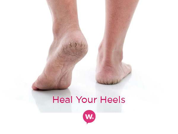 20190319-heal-your-cracked-heels
