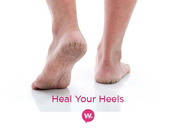 How to Heal Cracked Heels and Feet